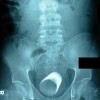 Quest uomo si è infilato un bicchiere nel sedere