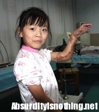 La bimba con la mano attaccata alla gamba è stata operata