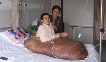 Tumore di 90 chili in Vietnam (2)